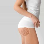 body cellulite