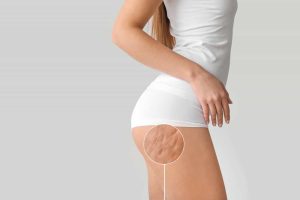 body cellulite