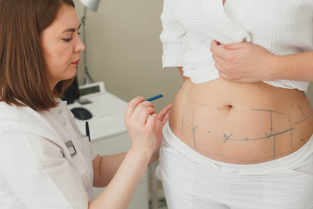liposuction surgeon drawing lines on a woman