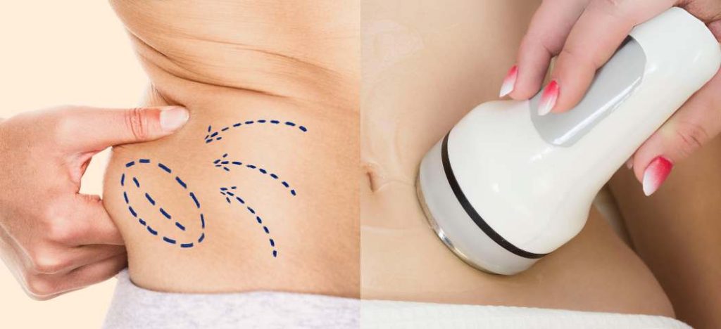 liposuction versus non surgical banner
