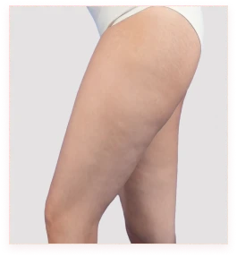 side view before.webp